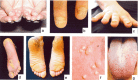 图1。 。 先天性厚甲症的常见表现包括：增厚和营养不良的指甲（手指甲和脚趾甲）(ac)； 大疱（通常在脚跟和脚底的压力点）； 角化过度 (de);  囊肿 (f);  和口腔白角化症（g）。