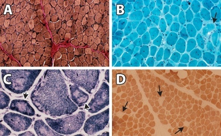 Figure 2. . Skeletal muscle histology of two children with Salih myopathy taken at age four years (A and D) and 14 years (B and C).